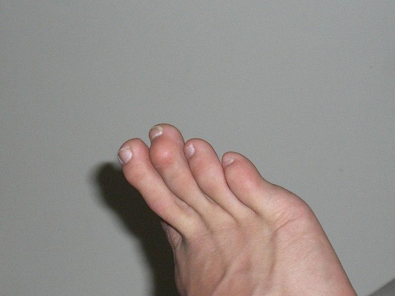 jari tengah kaki sakit ketika dipijat
