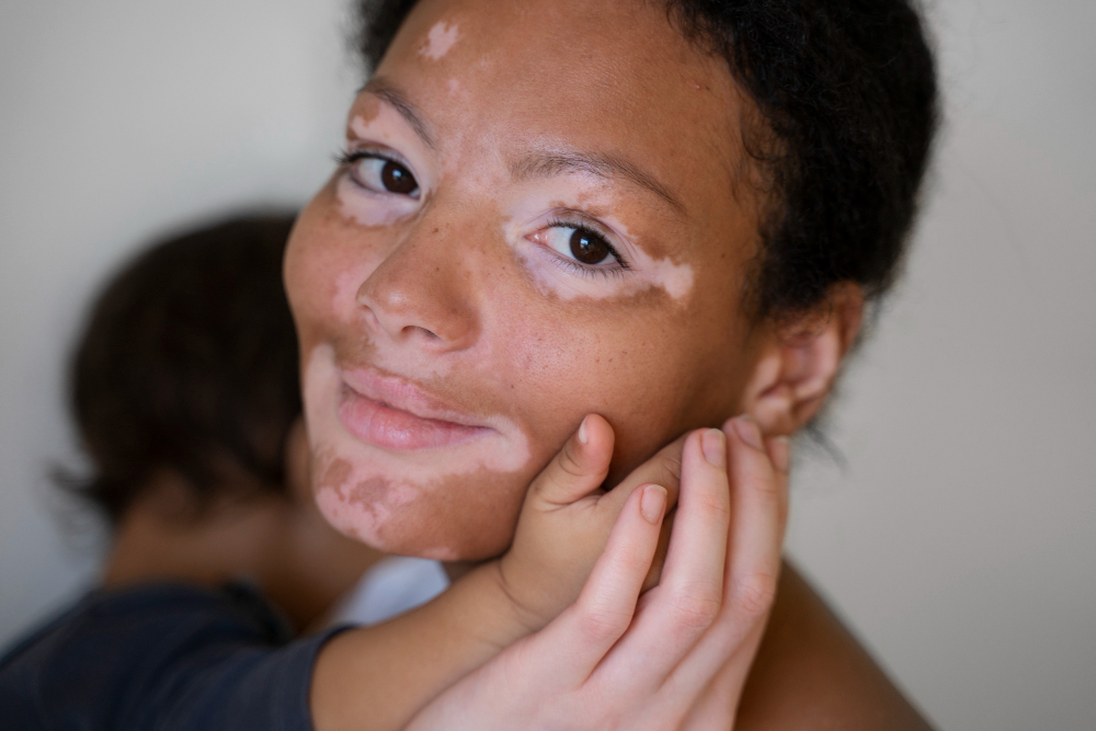 vitiligo pada rambut