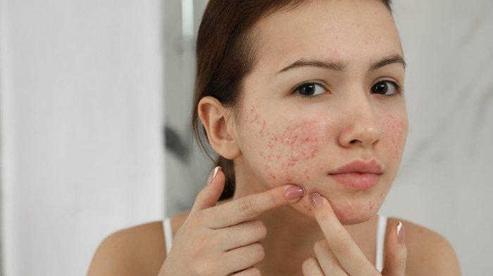urutan pemakaian skincare untuk kulit berminyak dan berjerawat